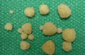 Кристаллы оксалатов
Фото