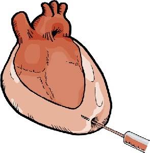 Перикардиоцентез Фото